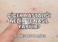 Çiçek Hastalığı Nedir ve Nasıl Yayılır?