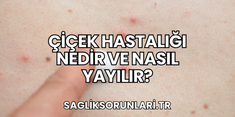 Çiçek Hastalığı Nedir ve Nasıl Yayılır?