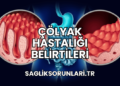 Çölyak Hastalığı Belirtileri