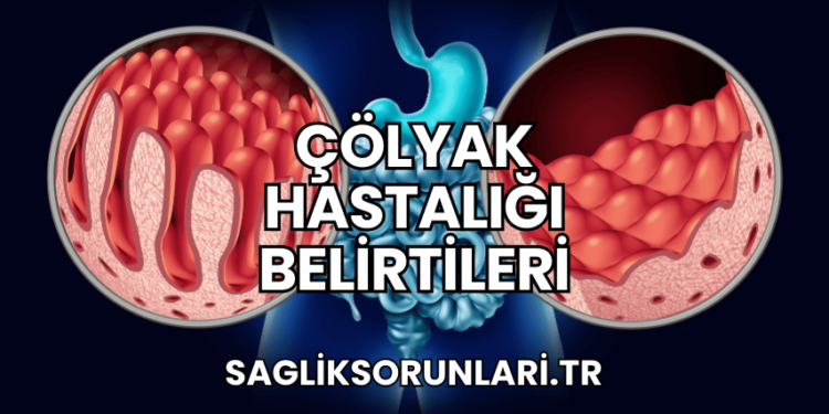 Çölyak Hastalığı Belirtileri