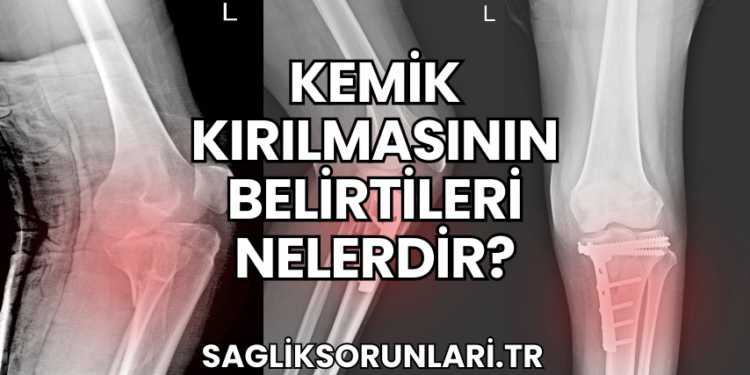 Kemik Kırılmasının Belirtileri Nelerdir?