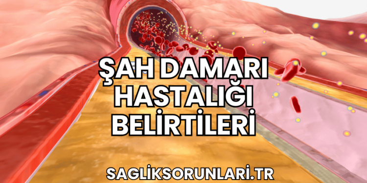 Şah Damarı Hastalığı Belirtileri