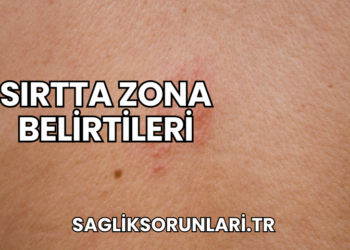 Sırtta Zona Belirtileri