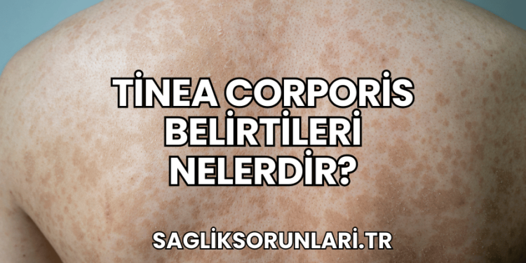 Tinea Corporis Belirtileri Nelerdir?