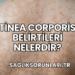 Tinea Corporis Belirtileri Nelerdir?