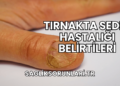 Tırnakta Sedef Hastalığı Belirtileri