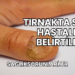 Tırnakta Sedef Hastalığı Belirtileri