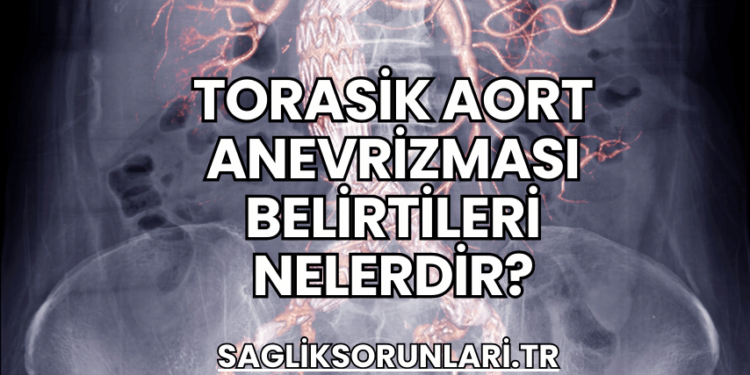 Torasik Aort Anevrizması Belirtileri Nelerdir?