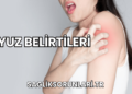 Uyuz Belirtileri