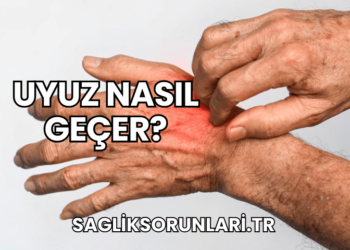 Uyuz Nasıl Geçer?