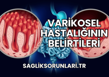 Varikosel Hastalığının Belirtileri