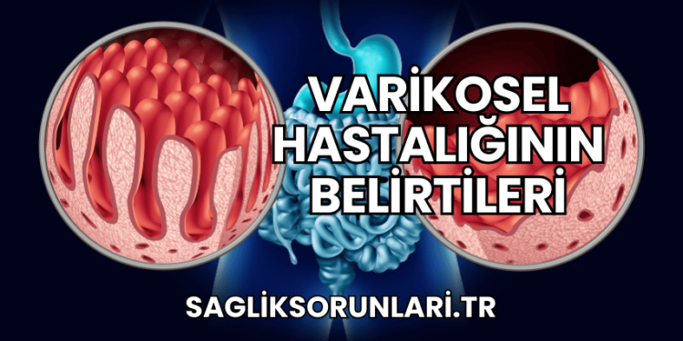 Varikosel Hastalığının Belirtileri