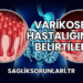 Varikosel Hastalığının Belirtileri