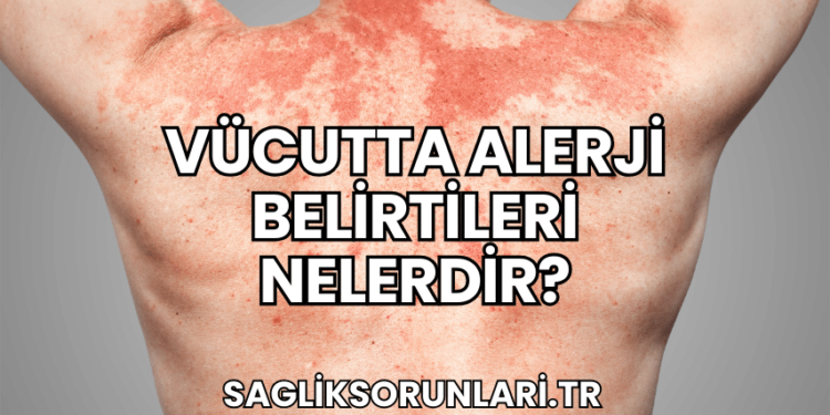 Vücutta Alerji Belirtileri Nelerdir?