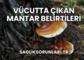 Vücutta Çıkan Mantar Belirtileri