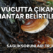 Vücutta Çıkan Mantar Belirtileri