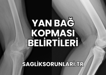 Yan Bağ Kopması Belirtileri