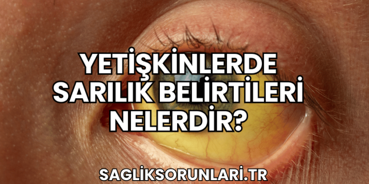 Yetişkinlerde Sarılık Belirtileri Nelerdir?
