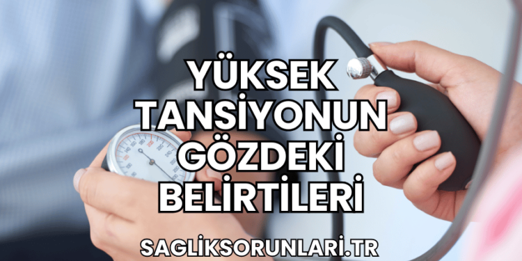 Yüksek Tansiyonun Gözdeki Belirtileri