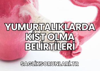 Yumurtalıklarda Kist Olma Belirtileri