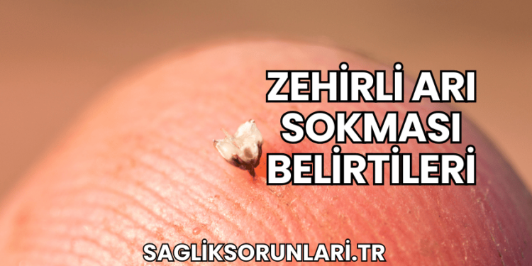 Zehirli Arı Sokması Belirtileri