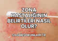 Zona Hastalığının Belirtileri Nasıl Olur?