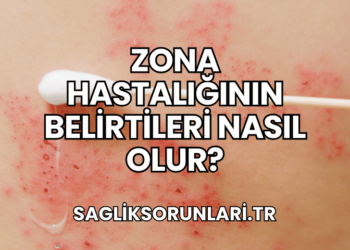 Zona Hastalığının Belirtileri Nasıl Olur?
