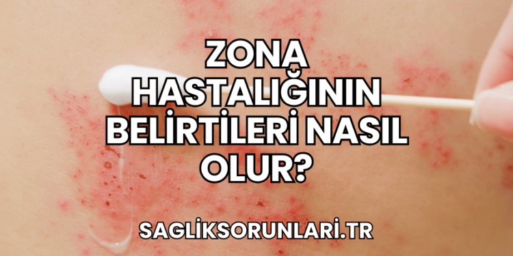 Zona Hastalığının Belirtileri Nasıl Olur?