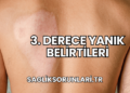 3. Derece Yanık Belirtileri