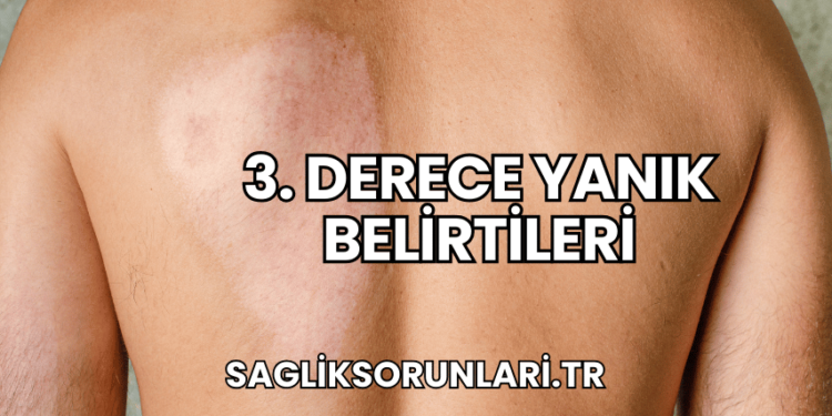 3. Derece Yanık Belirtileri