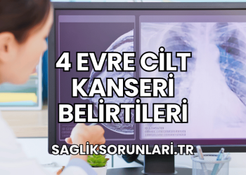 4 Evre Cilt Kanseri Belirtileri