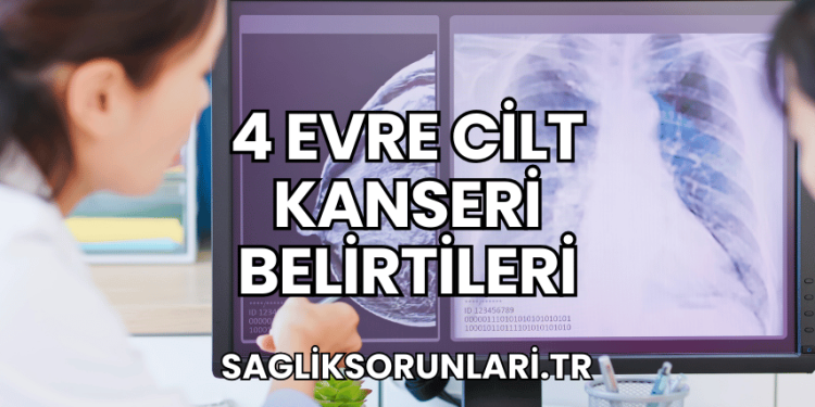 4 Evre Cilt Kanseri Belirtileri