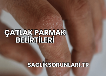 Çatlak Parmak Belirtileri