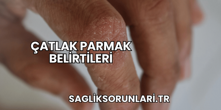 Çatlak Parmak Belirtileri