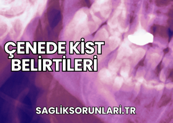 Çenede kist belirtileri