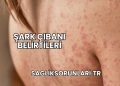 Şark Çıbanı Belirtileri