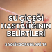 Su Çiçeği Hastalığının Belirtileri