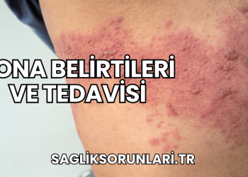 Zona Belirtileri ve Tedavisi