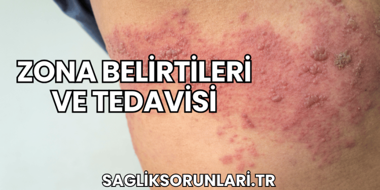 Zona Belirtileri ve Tedavisi