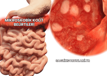 Mikroskobik Kolit Belirtileri