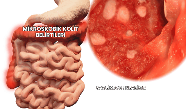 Mikroskobik Kolit Belirtileri
