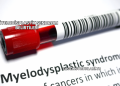 Miyelodisplastik Sendrom Belirtileri