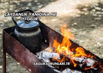Çaydanlık Yanığına Ne İyi Gelir?