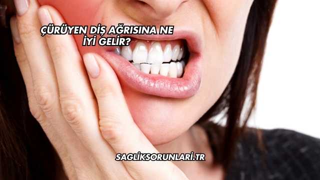 Çürüyen Diş Ağrısına Ne İyi Gelir?