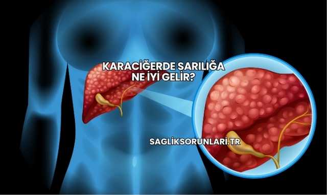 Karaciğerde Sarılığa Ne İyi Gelir?