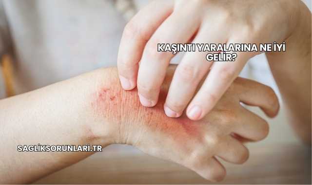 Kaşıntı Yaralarına Ne İyi Gelir?