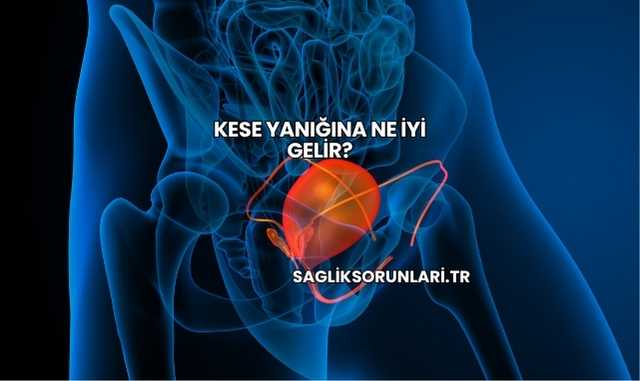 Kese Yanığına Ne İyi Gelir?