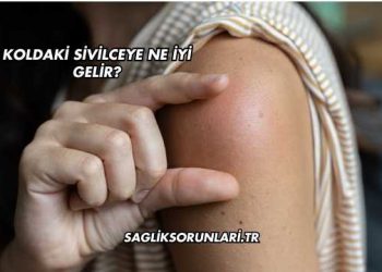 Koldaki Sivilceye Ne İyi Gelir?