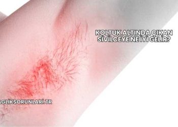 Koltuk Altında Çıkan Sivilceye Ne İyi Gelir?