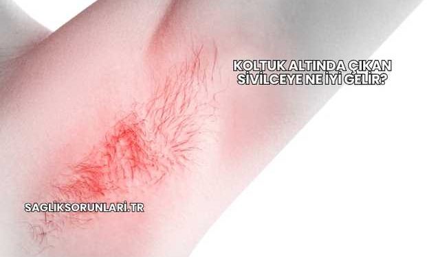 Koltuk Altında Çıkan Sivilceye Ne İyi Gelir?